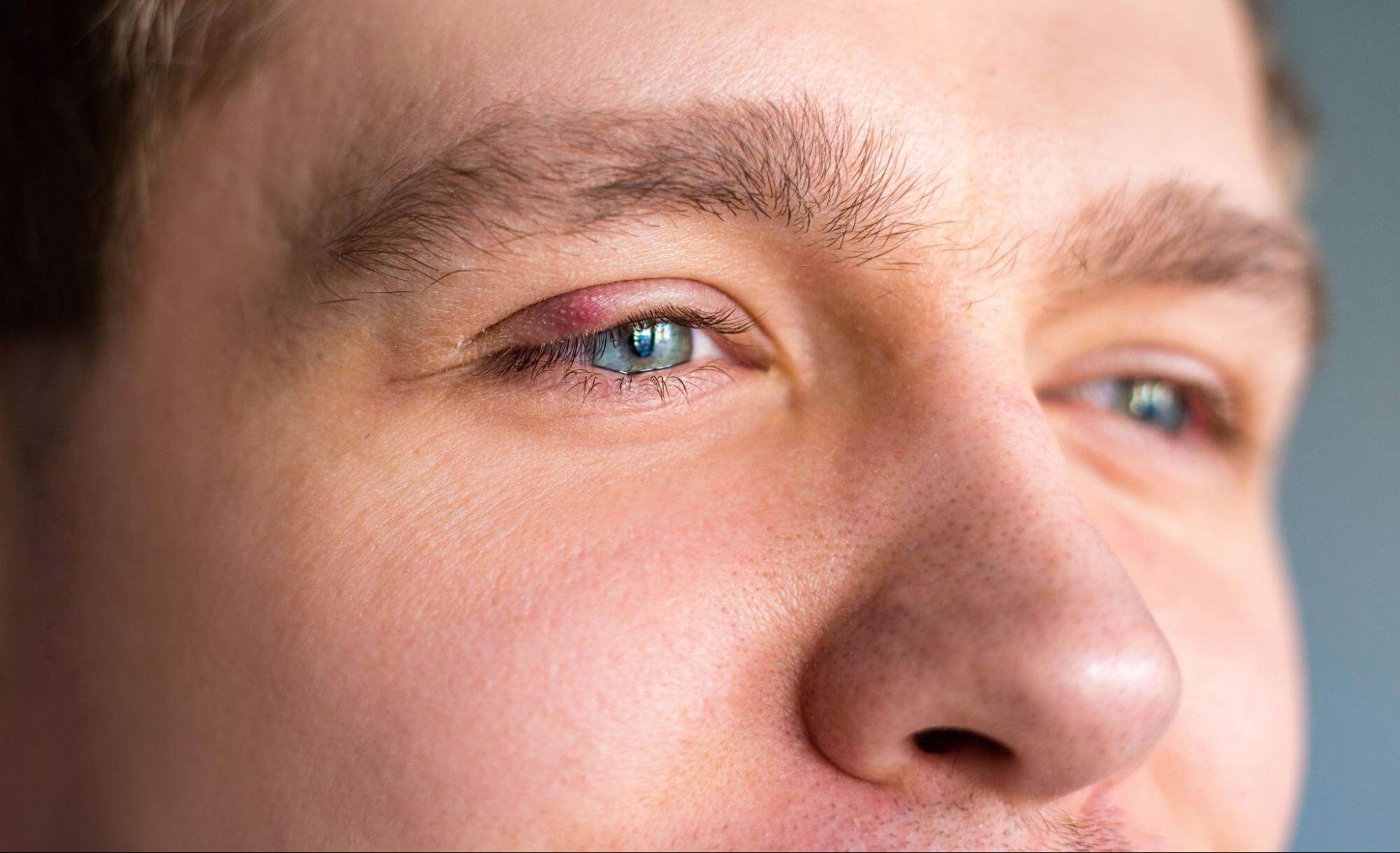 A close-up of a person's eye showing a red, swollen bump on the upper eyelid, characteristic of a stye or clogged meibomian gland.