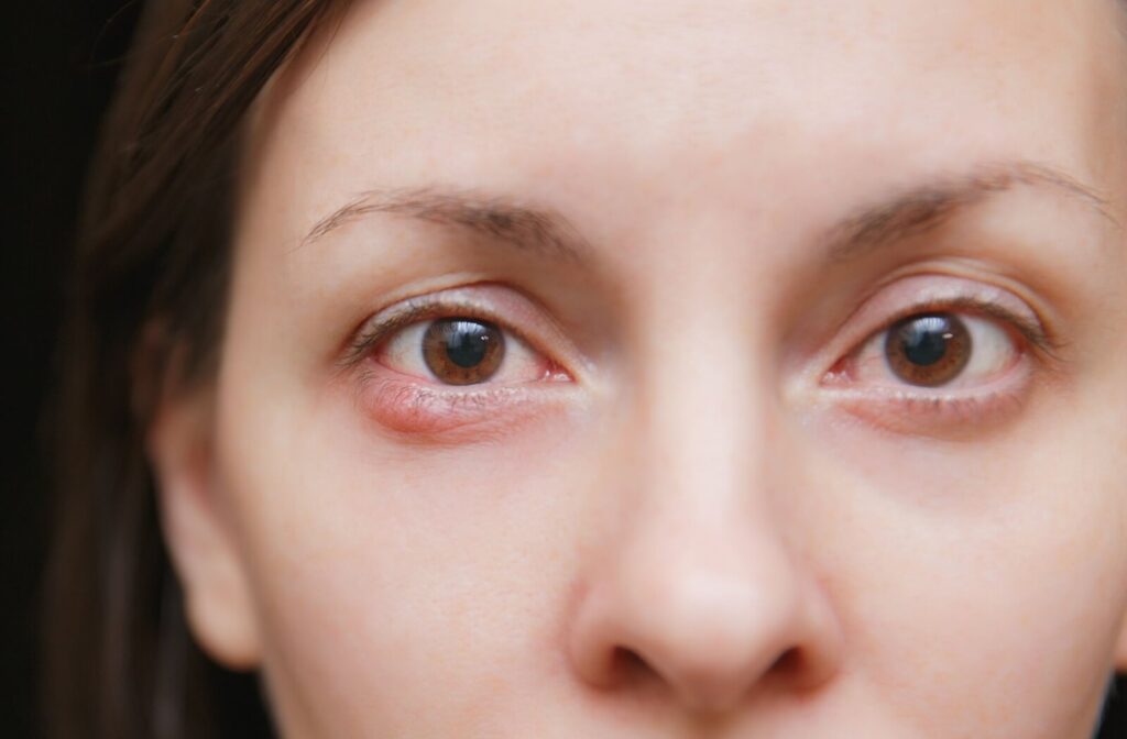 A close-up of a woman’s face showing a red, inflamed, and swollen lower eyelid caused by a blocked meibomian gland.